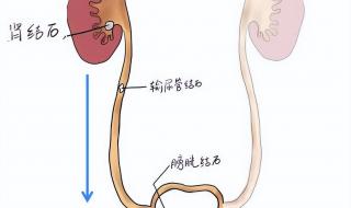 有结石怎么排出